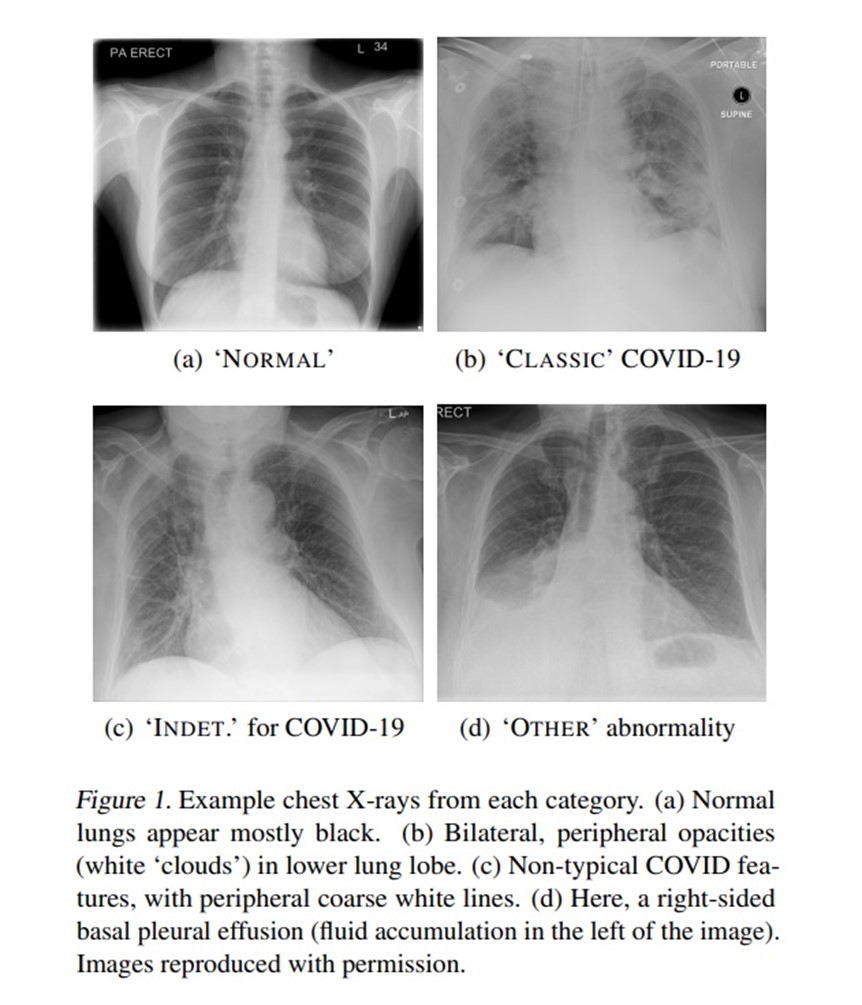 Supporting clinicians to diagnose and assess Covid-19 severity using AI ...
