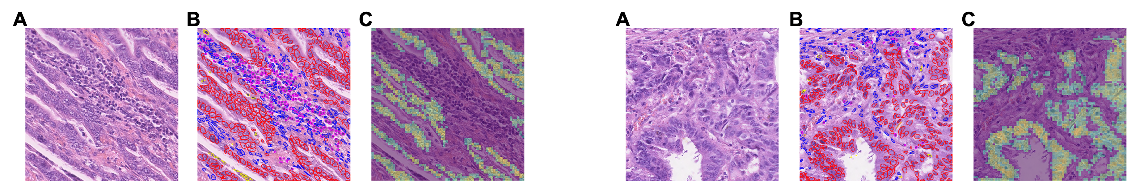 Left to right: An image of H&E stainedcolorectal tissue, the same image with expert annotation of cell types, and the same image with the most prominent features as determined by Virchow. Continuing, a second image of H&E stained colorectal tissue, the same image with expert annotation of cell types, and the same image with the most prominent features as determined by Virchow. In both cases, Virchow highlights the cancer cells.