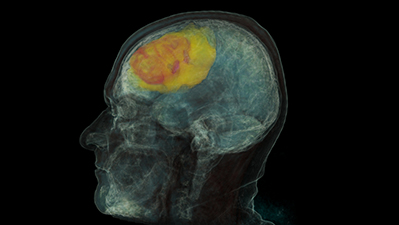 Project InnerEye: medical image of a skull
